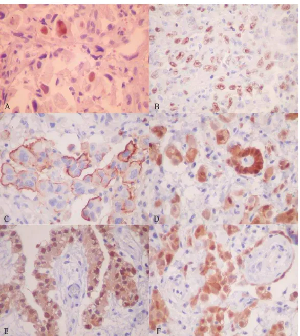 Figura  3 -  (A a  F) Imunohistoquímica para mesotelioma epitelial maligno: padrão nuclear visualizado para Ki-67 (A) e p53 (B)