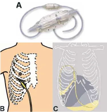 Figure 2 - "Pleuroperitoneal shunt": A) catheter with interposed receptacle (unidirectional valve); B) insertion of one of the extremities into the pleural cavity; and C) shunt in position, draining fluid from the pleural cavity and directing it to