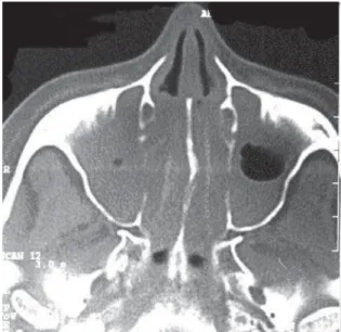 Figure 1 - Computed tomography of the paranasal sinuses.