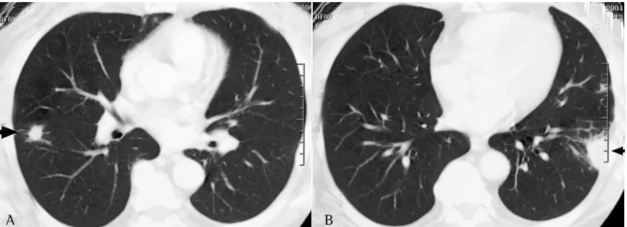 Figure 1 - A and B: Computed tomography of the chest revealing a right-sided pulmonary nodule and a triangular opacity in the lower left lobe with its base angled toward the pleura