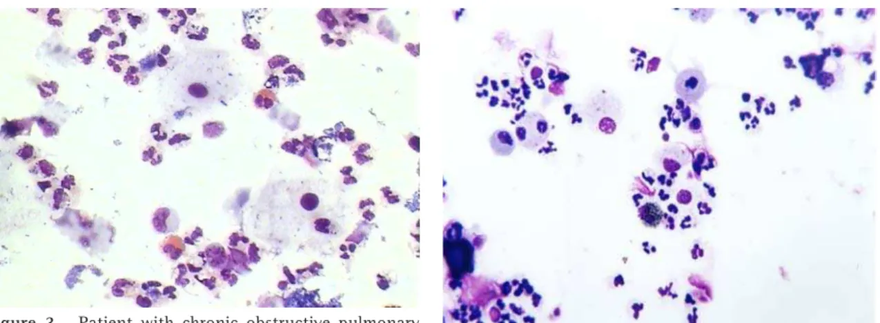 Figure 3 - Patient with chronic obstructive pulmonary disease without exacerbation for more than two months with eosinophils in induced-sputum material