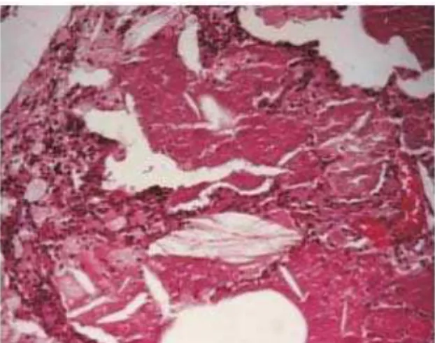 Figure 1 - Anatomopathological examination of pulmonary alveolar proteinosis
