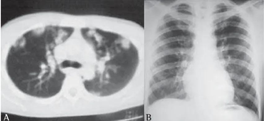 Figure 5 - A) Computed tomography of the chest at the time of diagnosis;