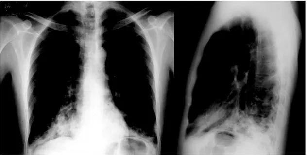 Figure 1 - Anteroposterior chest X-ray revealing areas of consolidation in both lower lobes (predominantly on the right side) and widening of the trachea and bronchi
