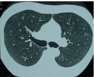 Figure 3 - Computed tomography of the chest with multiplane three-dimensional reconstruction revealing the abnormal dimensions of the trachea and main bronchi