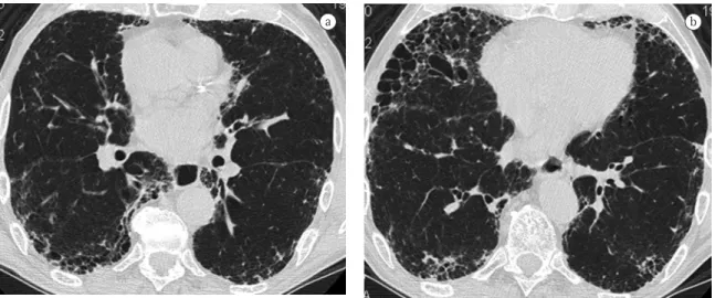 Figure 1 - Example of extent of disease score obtained on high-resolution computerized tomography of an 80-year-old  man with idiopathic pulmonary fibrosis