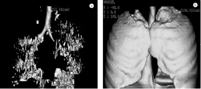 Figure 6 - Example of densitometry and volumetric assessment in a patient with incipient emphysema: on the left)  areas in which the density is similar to that of emphysema; and on the right) total lung capacity.