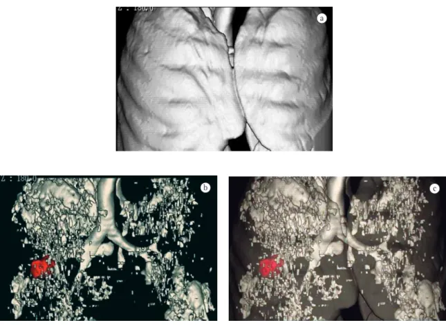 Figure 7 - Densitometry and volumetric assessment in a patient with bronchial carcinoma