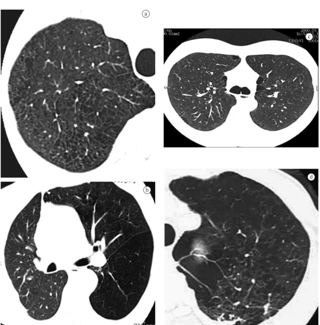 Figure  2  -  Computed  tomography  (CT)  and  high-resolution  CT  (HRCT)  images:  a)  representation  of  centrilobular  emphysema - CT reveals predominant degree  III  and  IV  lesions; b) representation of panlobular emphysema obtained  by HRCT of pat