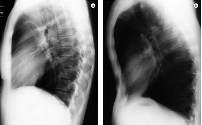 Figure 4 - X-rays in profile: a) normal patient; and b) increased retrosternal clear space and partial rectification of  the diaphragm, alterations which are, at least in part, justified by the modifications in the chest cavity (pronounced  kyphosis and mo