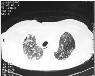 Figure 1 - High resolution computed tomography prior  to  the  evolution  to  pulmonary  condensation