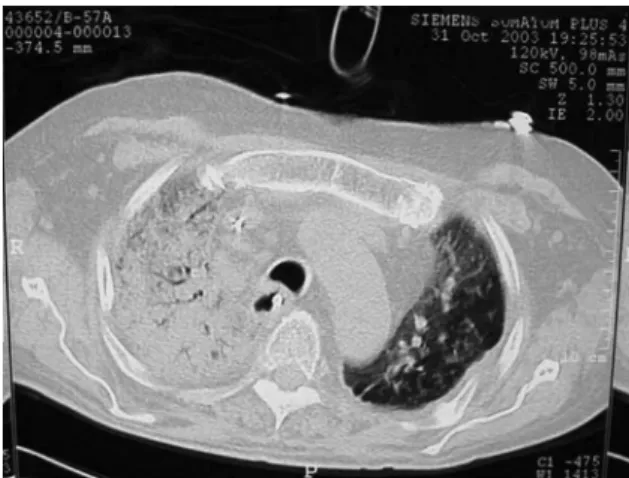 Figure  3  -  Histopathology  demonstrating  an  interstitial  pulmonary fibrosis (IPF) pattern