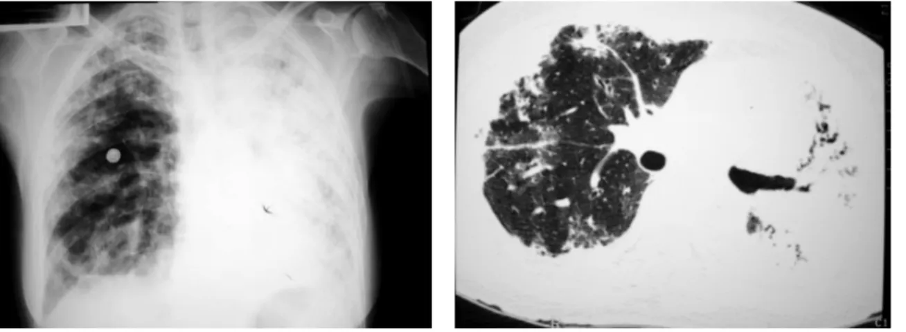 Figure  1  -  Initial  chest  X-ray.  Extensive  areas  of  consolidation, involving the entire left lung and presenting  predominantly peripheral distribution in the right lung.