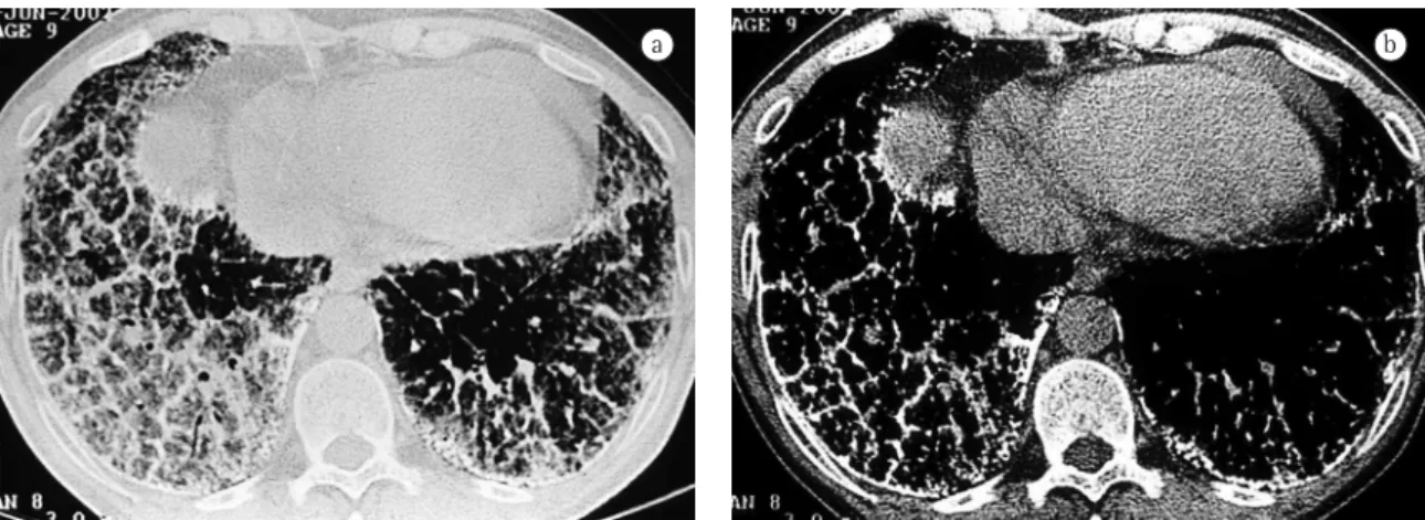 Figure 2- a) Intermediate window slice revealing ground-glass opacities with thickening of interposed interlobular  septa, characterizing a mosaic pattern of attenuation; and b) Mediastinal window slice showing calcification along the  interlobular septa a
