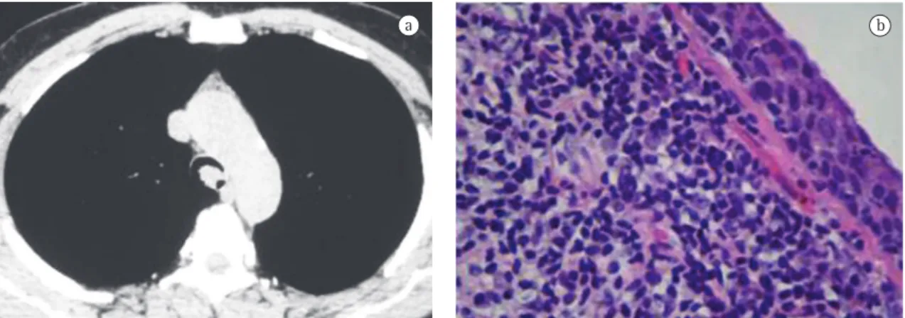 Figure 2 - a) Computed tomography of the chest showing vegetative lesion in the posterior region of the trachea,  obstructing 70-80% of its lumen; and b) Anatomopathological evaluation demonstrating squamous metaplasia of the  epithelial covering, chorion 