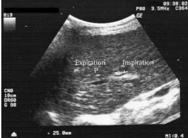 Figure  3  presents  the  mean  values  for  right  diaphragmatic mobility in RLD (51.30 ± 9.69 mm)  and LLD (45.93  ± 10.37 mm)
