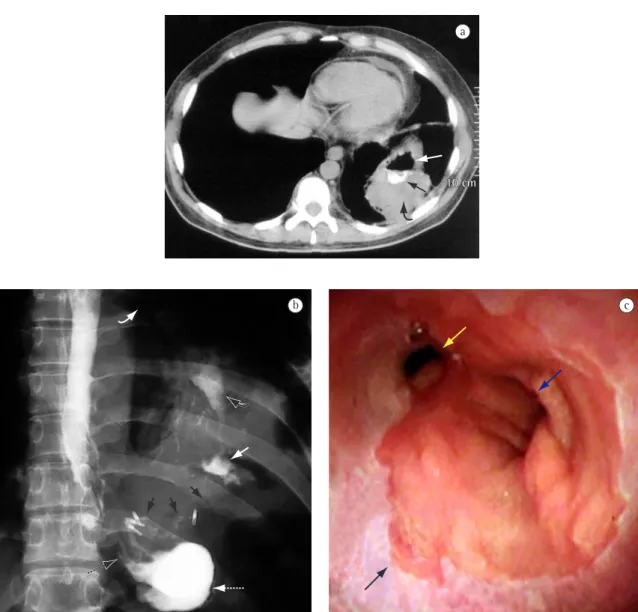 Figure 1 - Case 1: a) Computed tomography of the chest: abscess at the left lung base (curved black arrow) containing  air (white arrow) and contrast coming from the gastric pouch (black arrow); b) Contrast X-ray: fistula, beginning at  the  angle  of  His