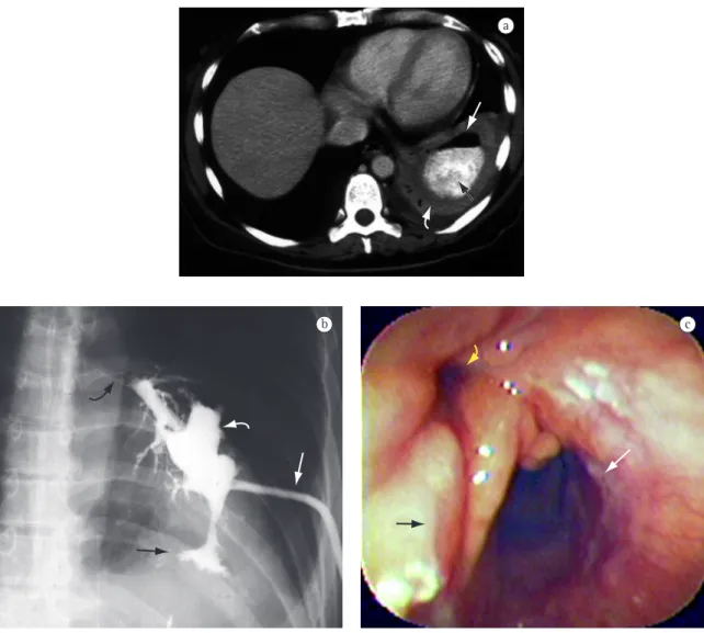 Figure 2 - Case 2: a) Computed tomography of the chest: abscess at the left lung base (curved white arrow) containing  air (white arrow) and contrast coming from the gastric pouch (black arrow); b) Contrast X-ray: catheter (white arrow)  draining lung absc