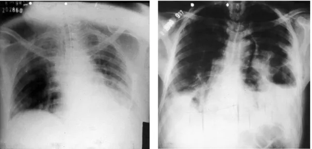 Figure  1  -  Chest  X-ray,  with  the  patient  in  the  supine  position,  showing  opacification  suggestive  of  pleural  effusion at the base of the left hemithorax (Case 1).