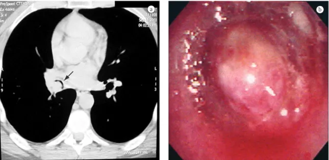 Figure 1 - Radiological and endoscopic aspects: a) Computed tomography scan of the chest showing nearly complete  obstruction of the lumen of the intermediate bronchus (arrow); and b) Endoscopic view of the tumor.