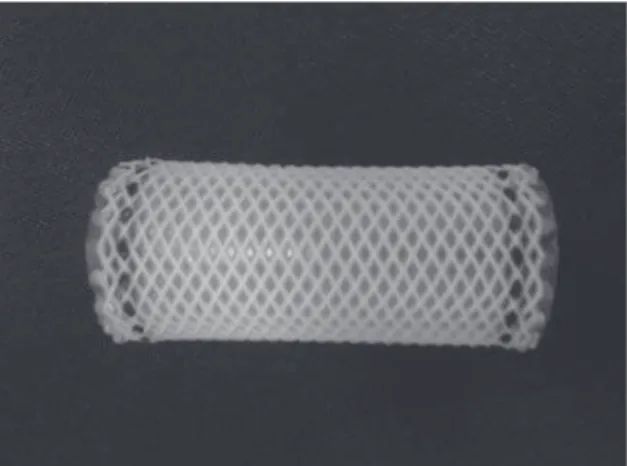 Figure 2 - Polyflex ®  stent within the trachea.