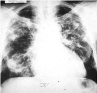 Figure 2 - Chest X-ray showing bilateral lung opacities  predominantly  in  the  middle  lobes  and  with  cavitation  in  the  left  upper  lobe