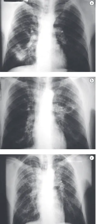 Figure  5  -  Sequential  imaging  of  a  given  patient:  a)  1997. Opacity in the left lung base: negativity for  acid-fast bacilli and positivity for  Paracoccidioides brasiliensis ;  b) 2004