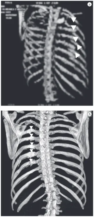 Figure  1  -  Computed  tomography  (CT)  of  the  chest  showing  ‘herniated’  rib  segment  within  the  cavity  compressing the lung.