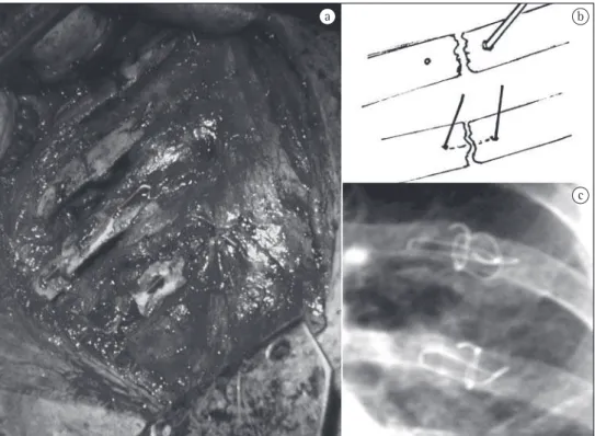 Figure 3 - Surgical act: a) reduced fractures and implantation of the steel wire; b) schematic technique of the costal  suture; and c) aspect on the X-ray.