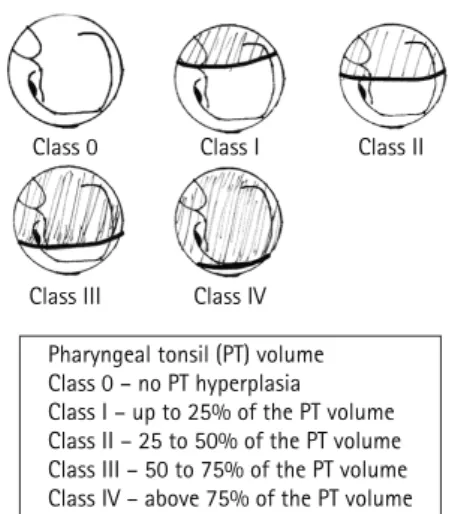 Figure 1 - Hyperplasia of the pharyngeal tonsils. Model  of nasal endoscopy classification.