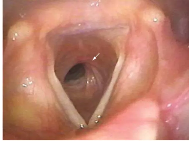 Figure 3 - Bronchoscopy: laryngotracheal stenosis.