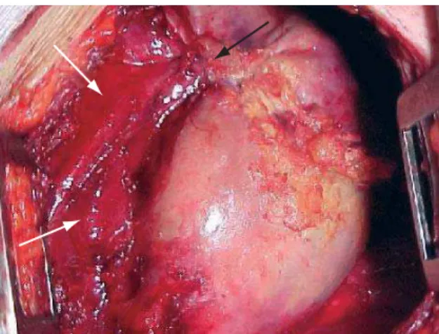 Figure 2 - Intraoperative image of the benign cystic  mediastinal teratoma revealing a capsule containing a  great quantity of yellowish secretion