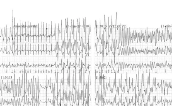 Figure 1- Holter electrocardiogram recorded during an exercise-related syncopal episode in a young girl with  CPVT showing a bidirectional VT degenerating into self-limiting VF