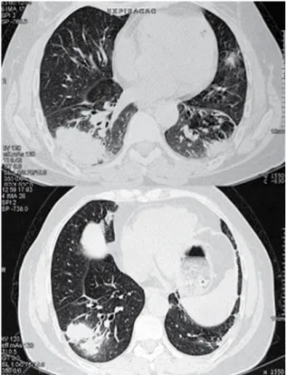 Figure  1  -  Computed  tomography  slices  of  the  chest  showing bilateral consolidations (Case 2).