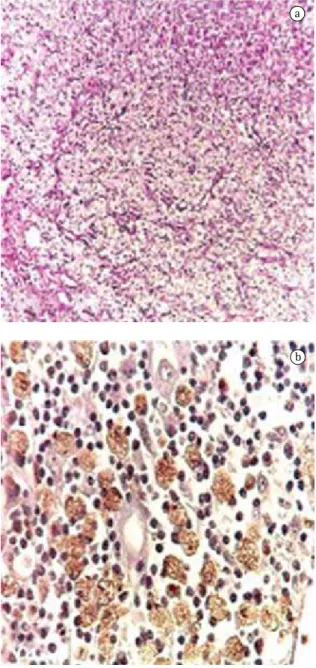 Figure  2  -  Histological  cervical  lymph  node  sections  showing  a  xanthogranulomatous  and  necrotizing  inflammatory process, without granuloma formation and  with  an  extensive  population  of  (CD68+)  xanthomatous  histiocytes, involving adjace