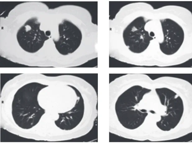 Figure 1 - Computed tomography slices of the chest (without contrast) showing multiple bilateral lung opacities.