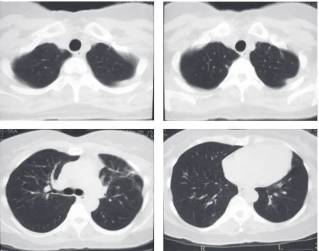 Figure 2 - Computed tomography slices of the chest (without contrast) showing near-complete resolution of the lung  opacities after treatment with antibiotics.