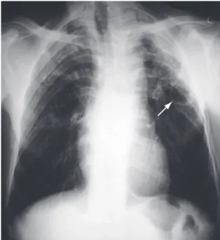 Figure  1  -  Chest  X-ray  of  a  patient  with  silicosis  and  pulmonary tuberculosis