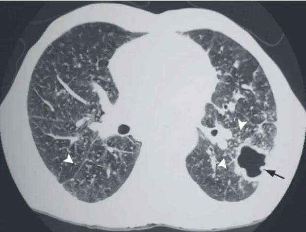 Figure  2  -  Tomography  scan  of  the  chest  of  the  same  patient.  Note  the  thick-walled  cavity  with  an  irregular  surface  in  the  left  lower  lobe  (black  arrow),  as  well  as  multiple, diffusely distributed nodules, predominantly in  th