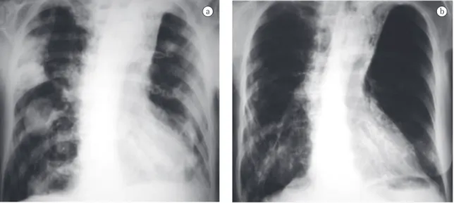 Figure 1 - Anteroposterior chest X-ray. In A, multiple nodules of various sizes, affecting both lungs