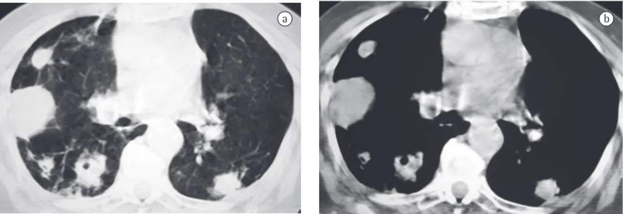 Figure 2 - Computed tomography scans with parenchymal (A) and mediastinal (B) window, showing multiple pulmonary  nodules of various sizes, some cavitated.