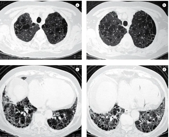 Figure 2 - High-resolution computed tomography slices of the chest showing emphysema in the lung apices (a and b)  and fibrosis, including honeycombing, in the lower regions of the lung (c and d).