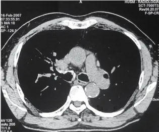 Figure  2  -  Bronchoscopic  views.  a)  Multiple  nodular  involvement  of  the  right  main  bronchi;  b)  Narrowing  of  the  intermediary lobar bronchi.
