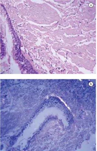 Figure 3 - a) Histopathological analysis of a tissue sample  shows eosinophilic masses of amyloid material; b) Congo  red staining demonstrating apple-green birefringence.
