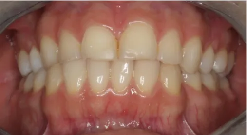 Figura 1 - Evidência de desgaste dentário no sector anterior 