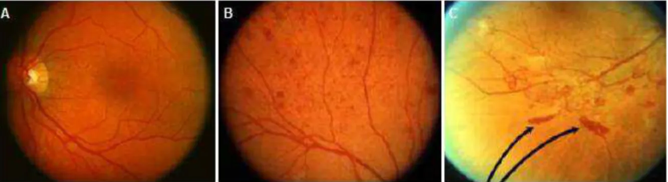 Figura 4 -  Angiografias mostrando a retina normal (A); retinopatia diabética não proliferativa  (B) e retinopatia diabética proliferativa (C)