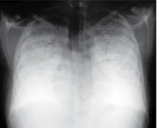Figure 1 - Anteroposterior chest X-ray. Diffuse bilateral  opacities,  with  calcium  density,  predominating  in  the  lower  halves  and  air  bronchogram  images  in  the  upper  thirds