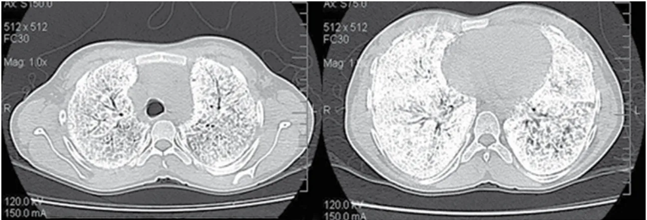 Figure  2  -  High-resolution  tomographic  axial  slices  of  the  lung  apices  and  bases