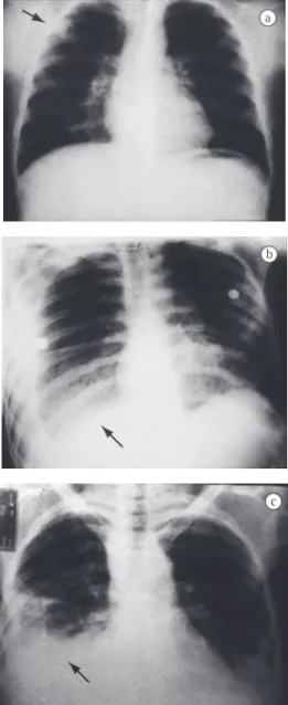 Figure 1 - Chest X-rays selected from among the cases: 