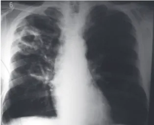 Figure 2 - Anteroposterior chest X-ray revealing lesions  (cavitation)  in  the  middle  and  upper  lobes  of  the  right  lung.